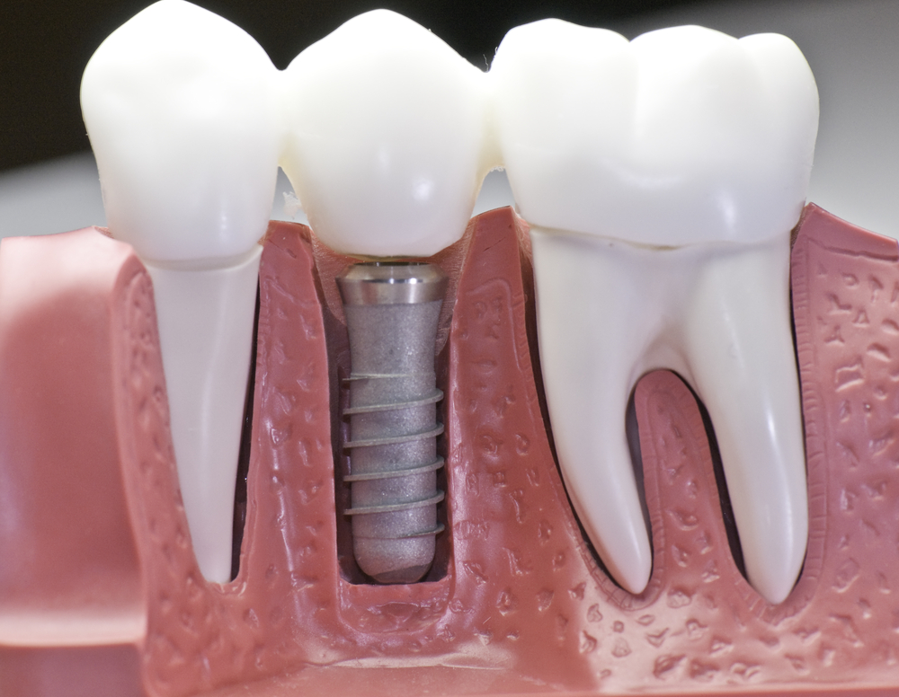 dental implant