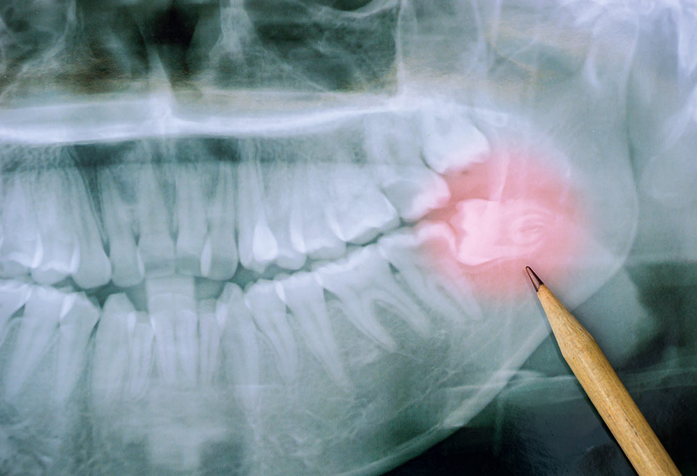 Wisdom tooth extraction