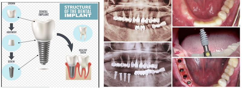 Same Day Teeth Replacements with Dental Implants in Berkeley Lake