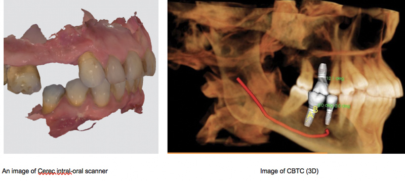 Same Day Teeth Replacements with Dental Implants in Berkeley Lake