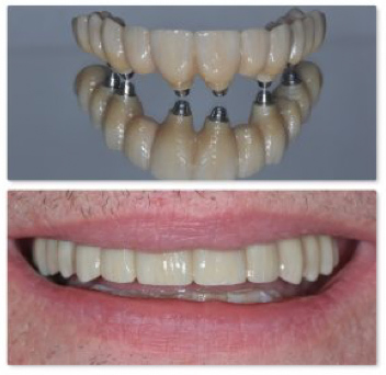 Same Day Teeth Replacements with Dental Implants in Berkeley Lake