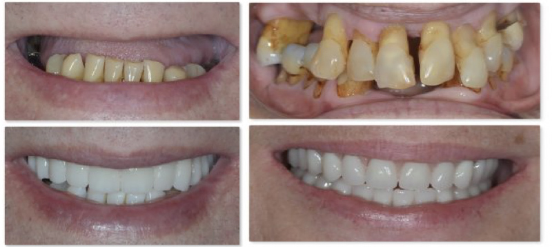 Same Day Teeth Replacements with Dental Implants in Berkeley Lake