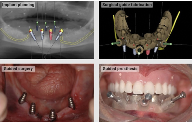 Same Day Teeth Replacements with Dental Implants in Berkeley Lake