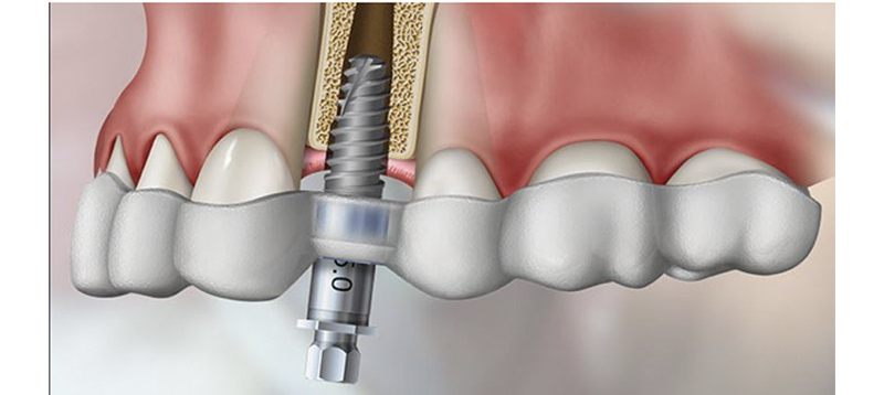 Same Day Teeth Replacements with Dental Implants in Berkeley Lake
