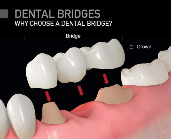 Same Day Dental Bridges in Berkeley Lake