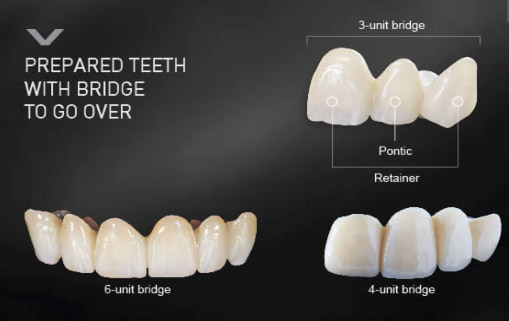 Same Day Dental Bridges in Berkeley Lake