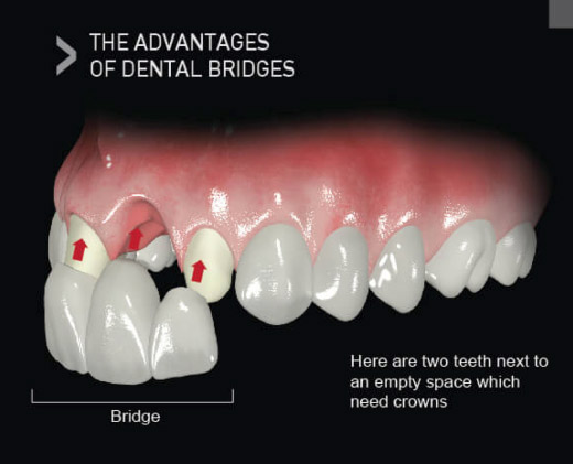 Same Day Dental Bridges in Berkeley Lake