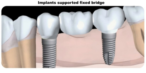 Dental Bridgesin Berkeley Lake