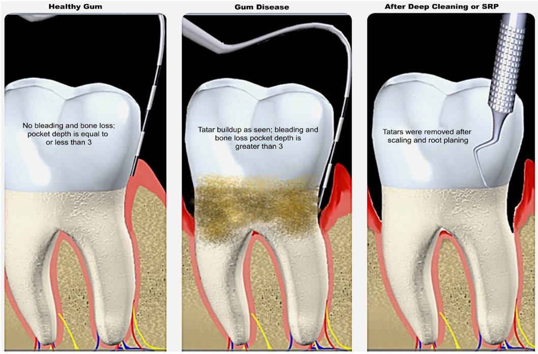 Deep Cleaning or Scaling and Root Planning 