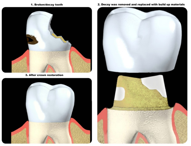 Same Day Dental Crowns in Berkeley Lake