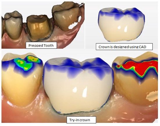 Same Day Dental Crowns in Berkeley Lake