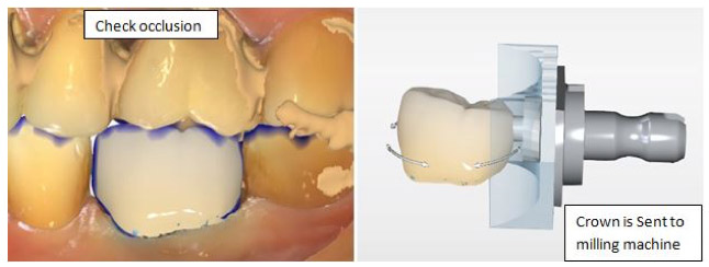 Same Day Dental Crowns in Berkeley Lake