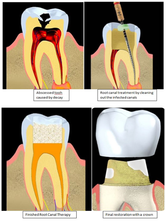 Root Canal Treatment in Berkeley Lake