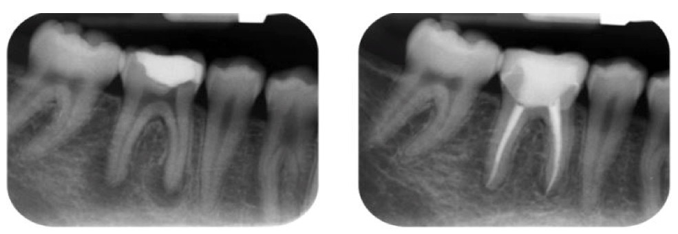 Root Canal Treatment in Berkeley Lake