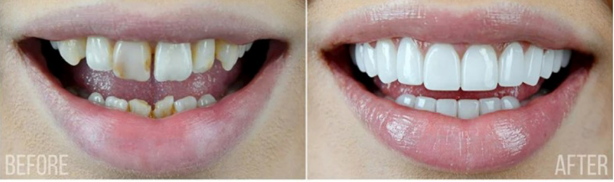 Cosmetic Dental Veneers in Berkeley Lake