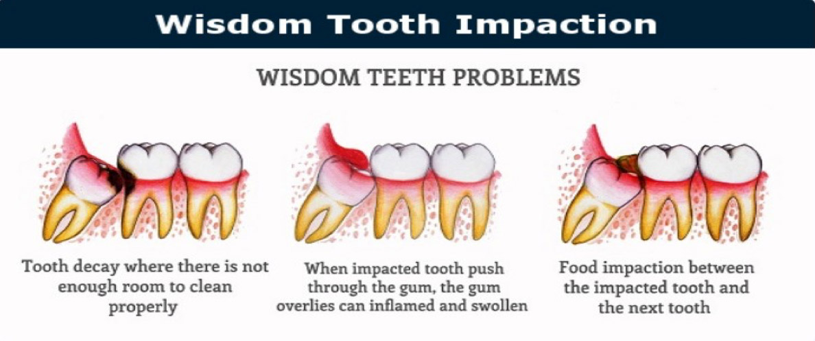 Wisdom Tooth Extraction